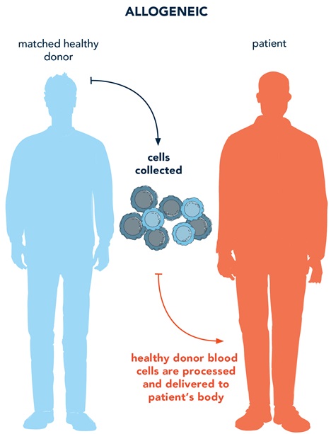 Image of allogeneic bone marrow transplant